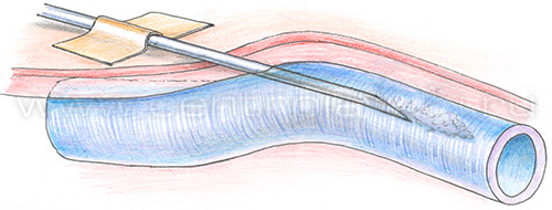 Введение иглы при внутривенной инъекции. Схема
