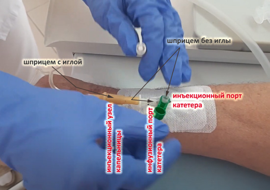 Технологические отверстия венозного катетера для проведения инъекций и других видов обслуживания. Схема