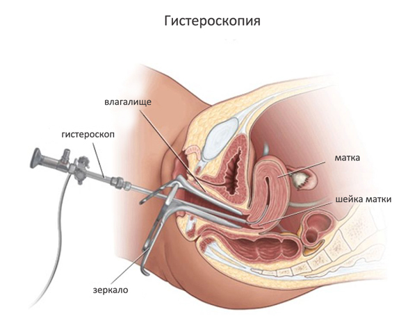 Гистероскопия матки. Схема