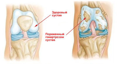 Как выглядит здоровый коленный сустав и пораженный гонартрозом