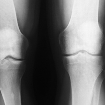 Рентгенограмма коленного сустава | Здоровый сустав