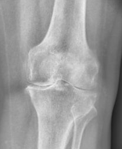 Рентгенограмма коленного сустава | Так выглядит вторая стадия гонартроза