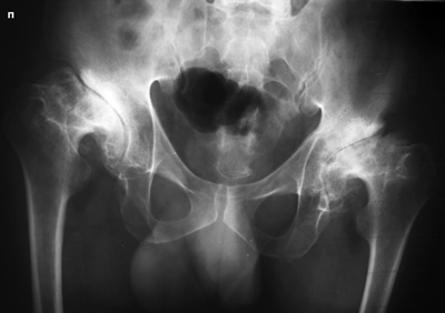 Рентгенограмма | Артроз тазобедренного сустава (коксартроз) с обеих сторон
