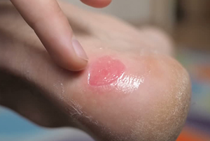 Как вылечить рану на ноге мокреющую thumbnail