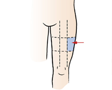 Определение места для укола в латеральную широкую мышцу путем условного деления поверхности бедра на 9 частей. Схема