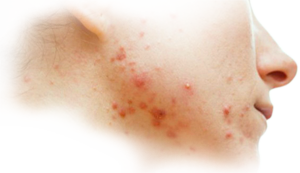 Заболевания кожи и подкожной клетчатки