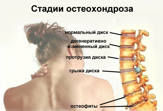 Симптомы и стадии шейного остеохондроза